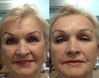 Goji Cream lietošanas pieredze - personīga fotogrāfija pirms un pēc