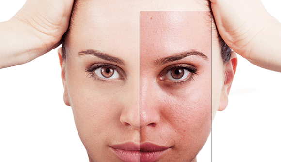 frakcionēta atjaunošana novērš galvenos estētiskos defektus uz sejas
