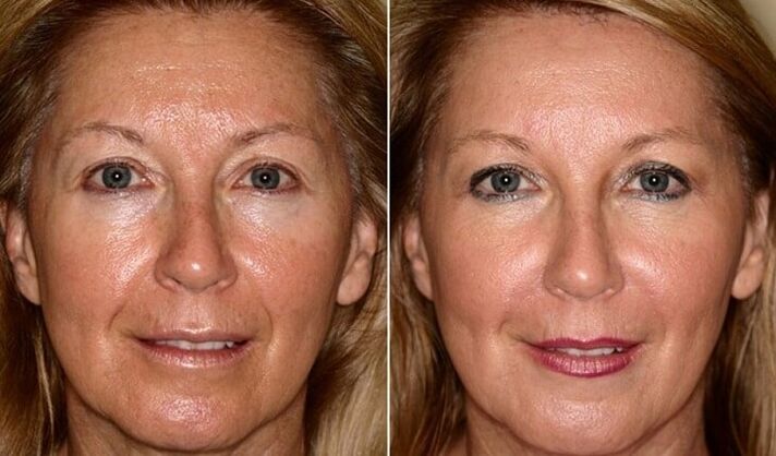pirms un pēc sejas ādas atjaunošanas mājās
