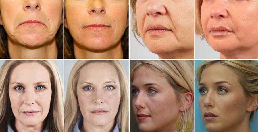 sieviešu fotogrāfijas pirms un pēc sejas ādas atjaunošanas